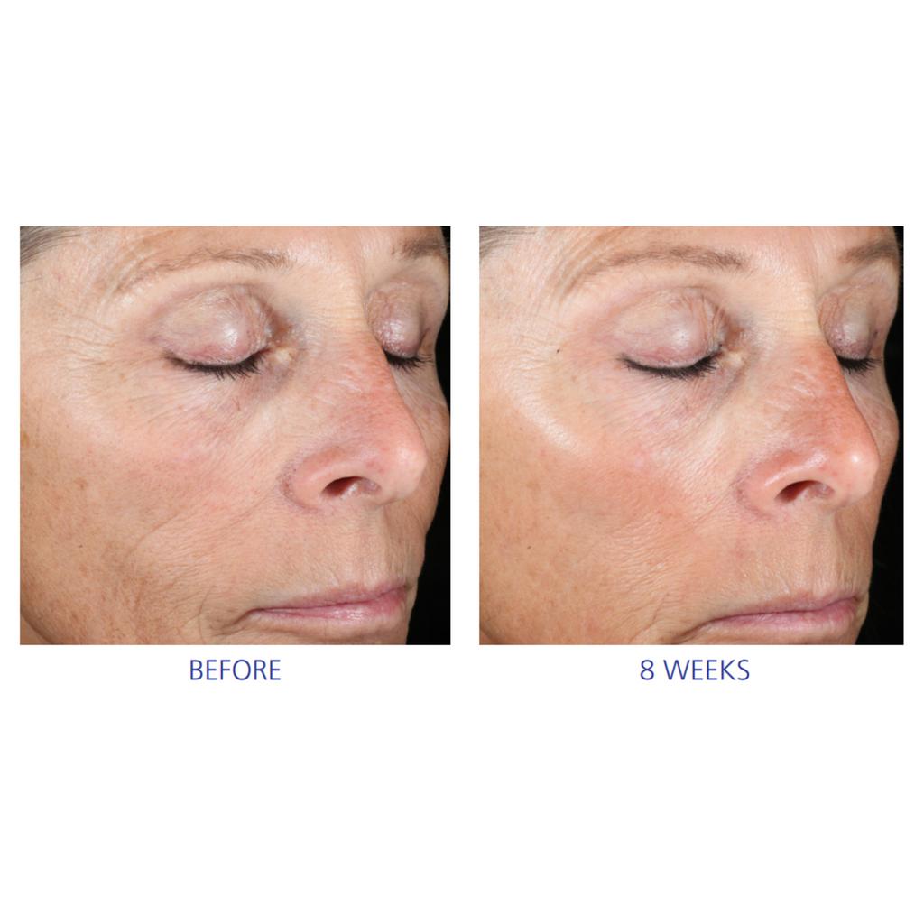 iS Clinical Active Peel System-Kits-Skintique Retail