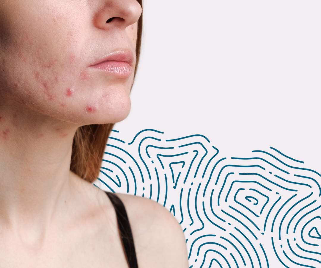 Why Blemishes Don’t Define Your Beauty