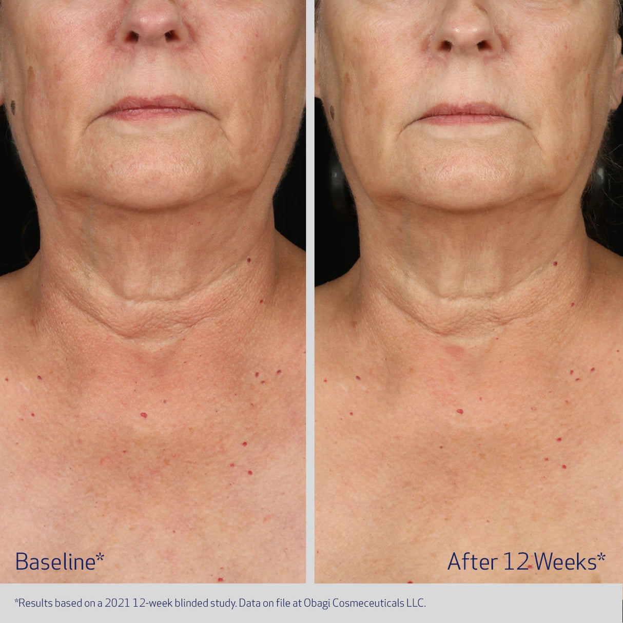 Obagi ELASTIderm Neck & Décolleté Concentrate | Anti-Ageing Serum | 60ml