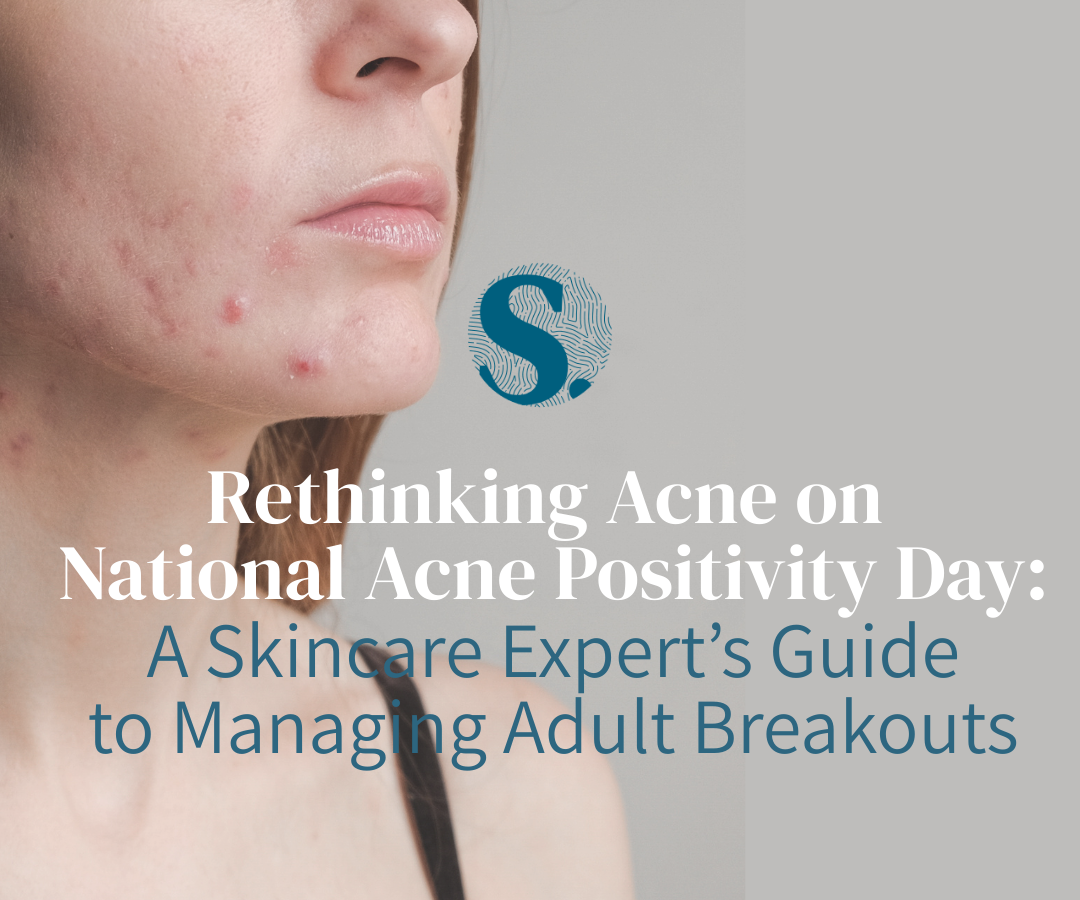 Guide to managing acne